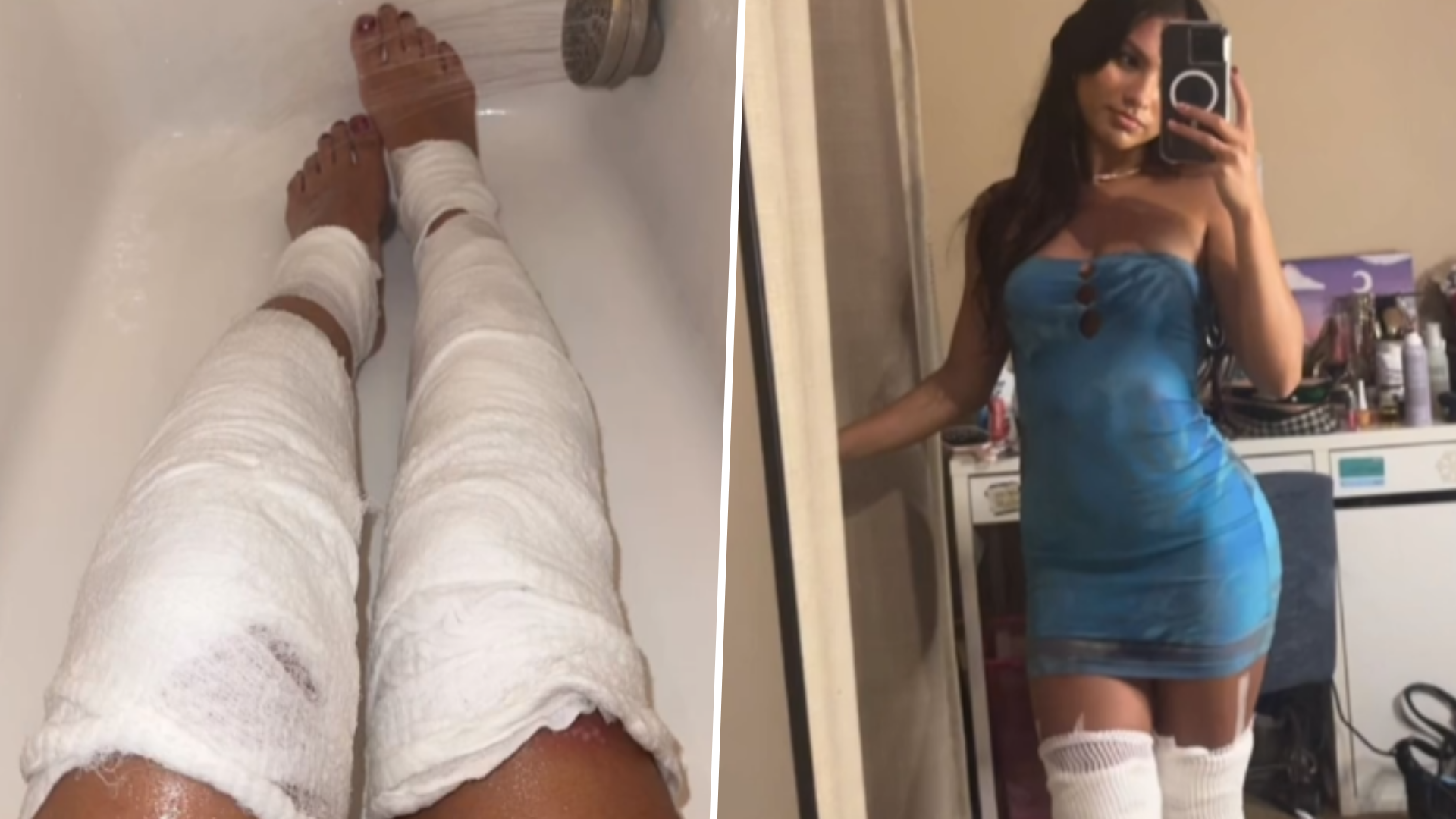 YouTube Prankster Leaves TikToke Star Amercado With Third-Degree Burns & Unpaid Medical Bills