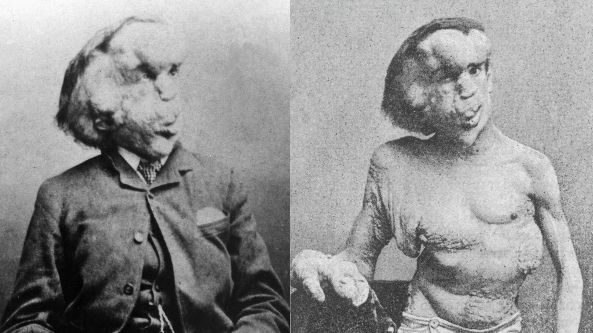 Joseph Merrick 01 Wikipedia